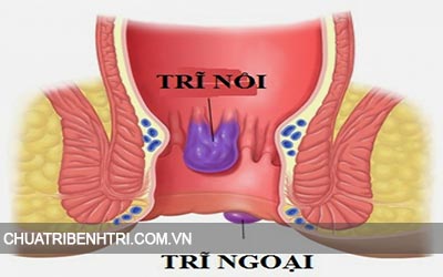 Bệnh trĩ ngoại là gì