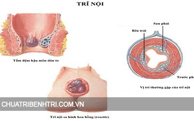 Bệnh trĩ nội là gì
