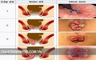 Những triệu chứng của bệnh trĩ nội